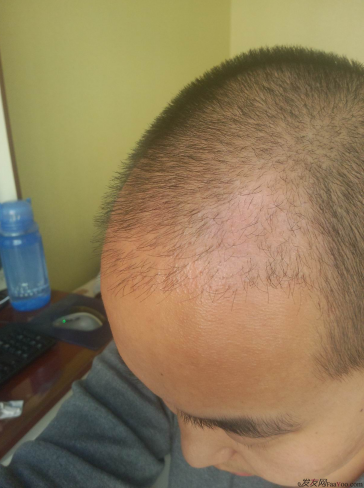 西安大麥微針植發(fā)案例，繼續(xù)看我逆襲蛻變