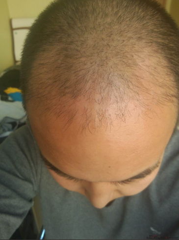 西安大麥微針植發(fā)案例，繼續(xù)看我逆襲蛻變