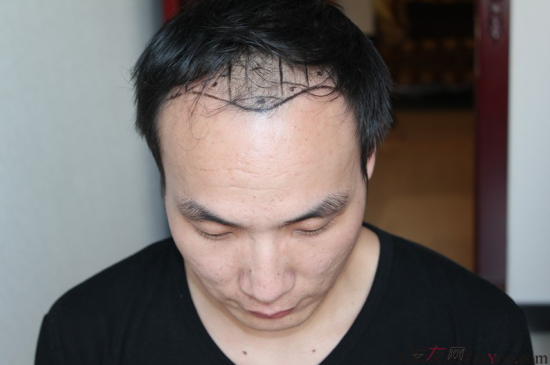 北京植發(fā)2700單位，我一步步的拾回了自信