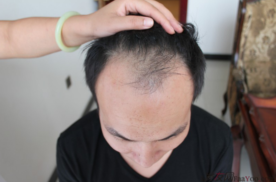 北京植發(fā)2700單位，我一步步的拾回了自信