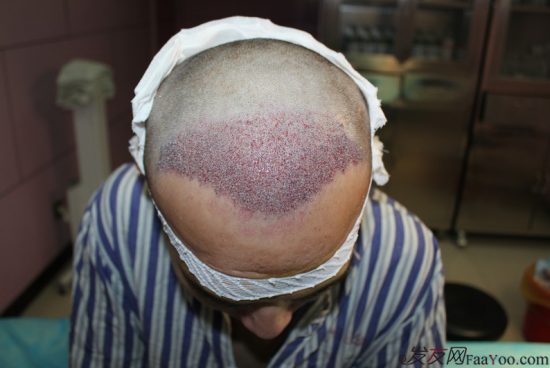 北京植發(fā)2700單位，我一步步的拾回了自信