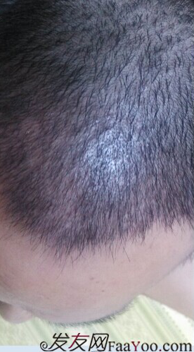 北京植發(fā)2700單位，我一步步的拾回了自信