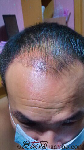 北京植發(fā)2700單位，我一步步的拾回了自信