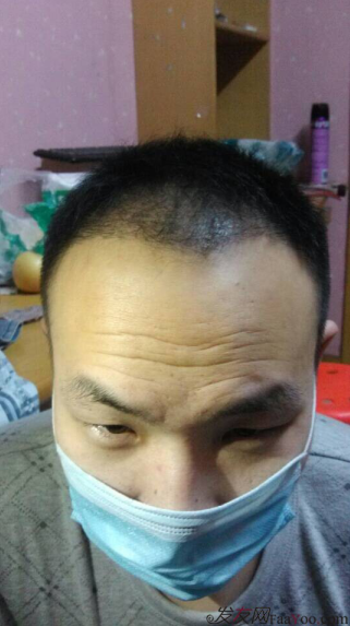 北京植發(fā)2700單位，我一步步的拾回了自信