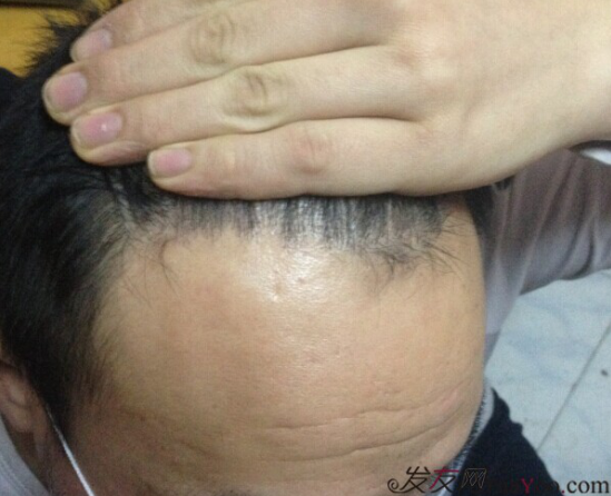 北京植發(fā)2700單位，我一步步的拾回了自信