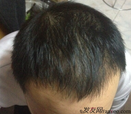 北京植發(fā)2700單位，我一步步的拾回了自信