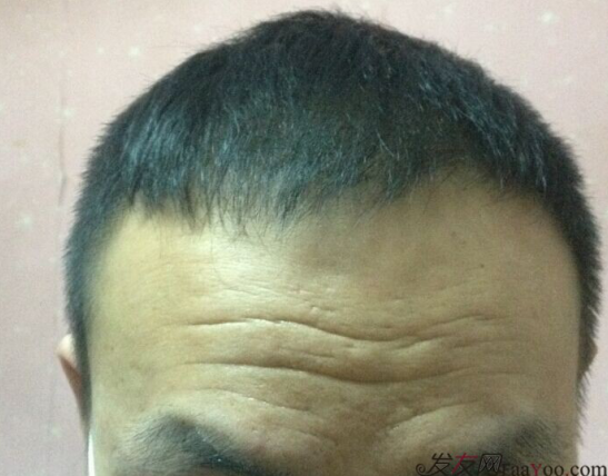 北京植發(fā)2700單位，我一步步的拾回了自信