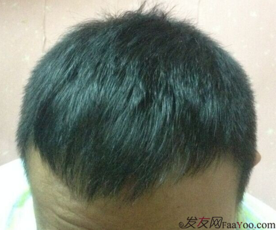 北京植發(fā)2700單位，我一步步的拾回了自信