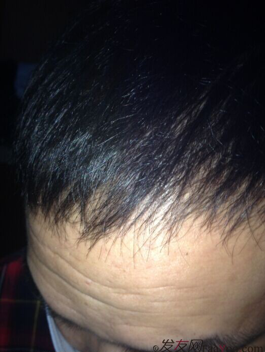 北京植發(fā)2700單位，我一步步的拾回了自信