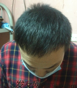 北京植發(fā)2700單位，我一步步的拾回了自信