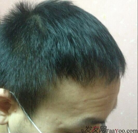 北京植發(fā)2700單位，我一步步的拾回了自信