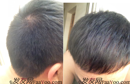 北京植發(fā)2700單位，我一步步的拾回了自信