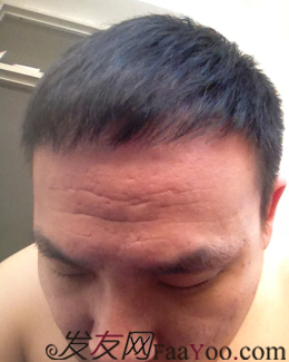 北京植發(fā)2700單位，我一步步的拾回了自信