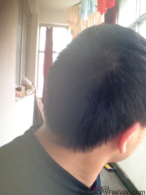 北京植發(fā)2700單位，我一步步的拾回了自信