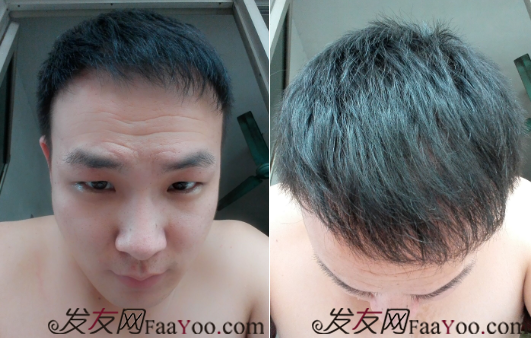 北京植發(fā)2700單位，我一步步的拾回了自信