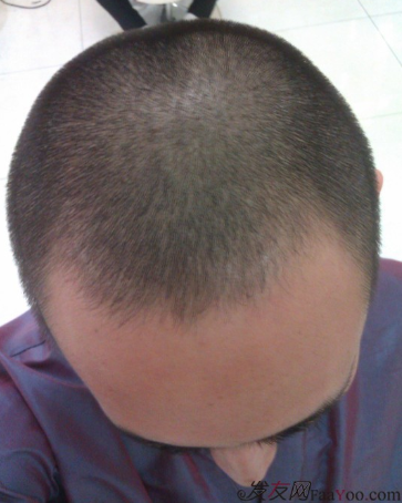 北京植信實(shí)錄發(fā)際線下調(diào)+額角加密2026個(gè)單位