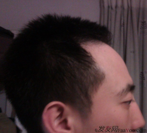 北京植信實(shí)錄發(fā)際線下調(diào)+額角加密2026個(gè)單位