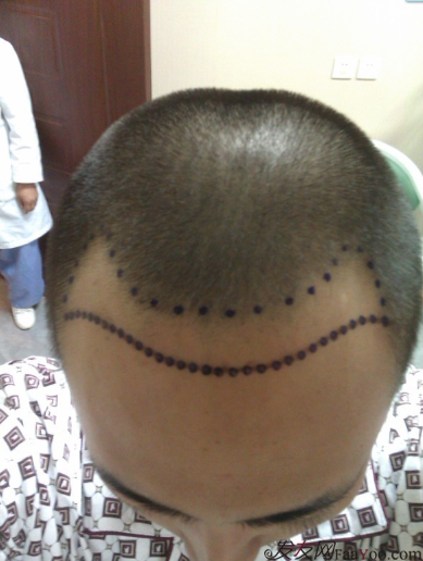 北京植信實(shí)錄發(fā)際線下調(diào)+額角加密2026個(gè)單位