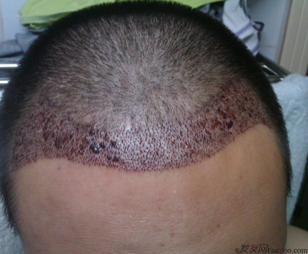 北京植信實(shí)錄發(fā)際線下調(diào)+額角加密2026個(gè)單位