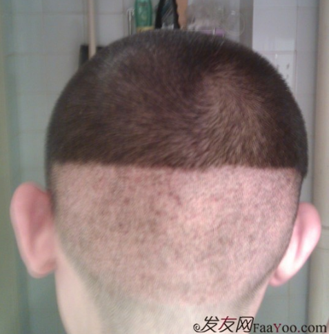 北京植信實(shí)錄發(fā)際線下調(diào)+額角加密2026個(gè)單位