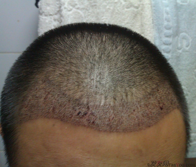 北京植信實(shí)錄發(fā)際線下調(diào)+額角加密2026個(gè)單位