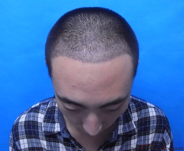 北京植信實(shí)錄發(fā)際線下調(diào)+額角加密2026個(gè)單位