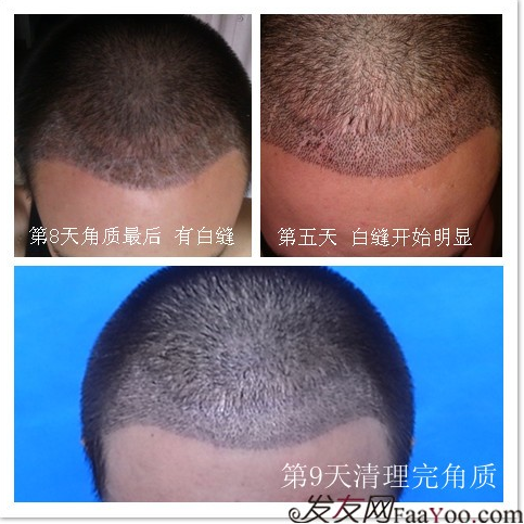 北京植信實(shí)錄發(fā)際線下調(diào)+額角加密2026個(gè)單位