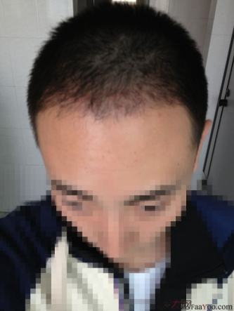 北京植信實(shí)錄發(fā)際線下調(diào)+額角加密2026個(gè)單位