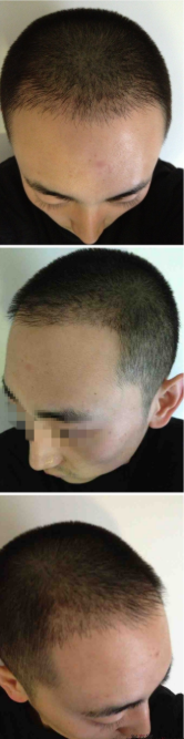 北京植信實(shí)錄發(fā)際線下調(diào)+額角加密2026個(gè)單位