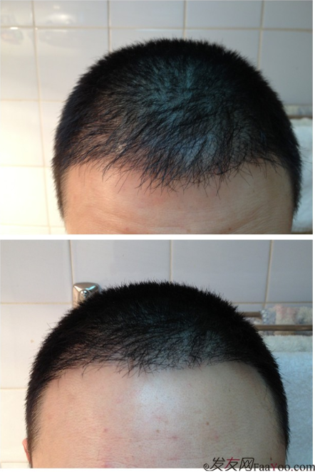 北京植信實(shí)錄發(fā)際線下調(diào)+額角加密2026個(gè)單位