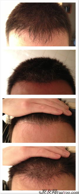 北京植信實(shí)錄發(fā)際線下調(diào)+額角加密2026個(gè)單位