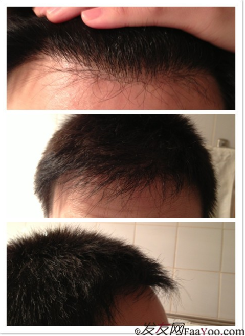 北京植信實(shí)錄發(fā)際線下調(diào)+額角加密2026個(gè)單位