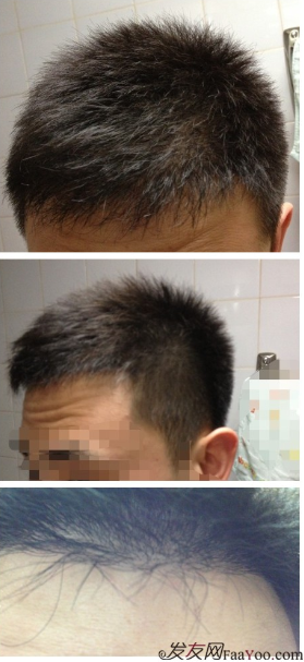 北京植信實(shí)錄發(fā)際線下調(diào)+額角加密2026個(gè)單位