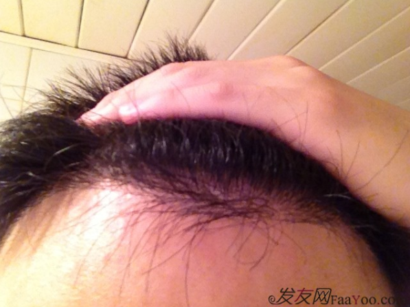 北京植信實(shí)錄發(fā)際線下調(diào)+額角加密2026個(gè)單位