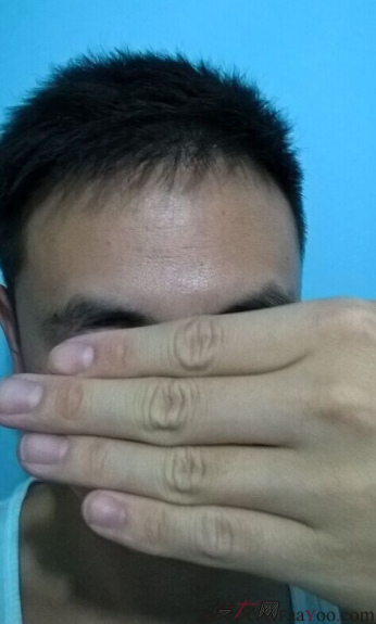 北京植信實(shí)錄發(fā)際線下調(diào)+額角加密2026個(gè)單位