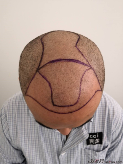 北京南加植發(fā)唐醫(yī)生種植3500單位一年效果恢復(fù)全程記錄