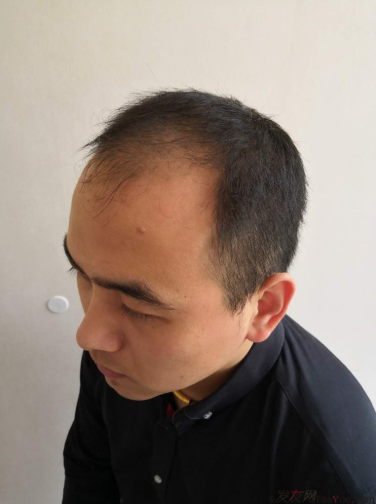 北京南加植發(fā)唐醫(yī)生種植3500單位一年效果恢復(fù)全程記錄