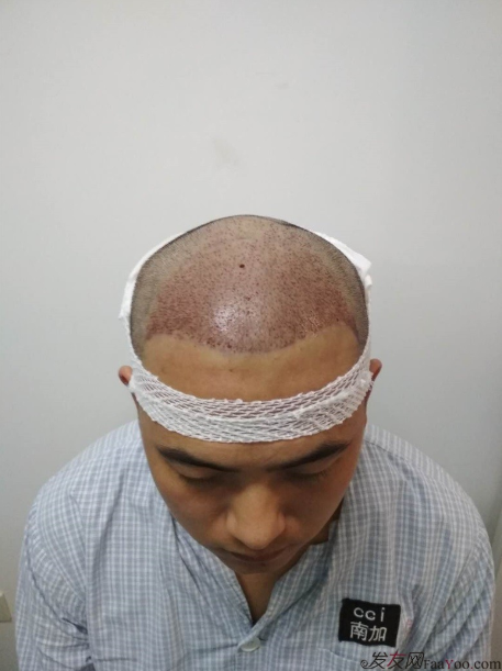 北京南加植發(fā)唐醫(yī)生種植3500單位一年效果恢復(fù)全程記錄