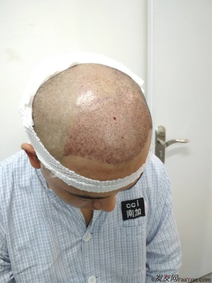 北京南加植發(fā)唐醫(yī)生種植3500單位一年效果恢復(fù)全程記錄