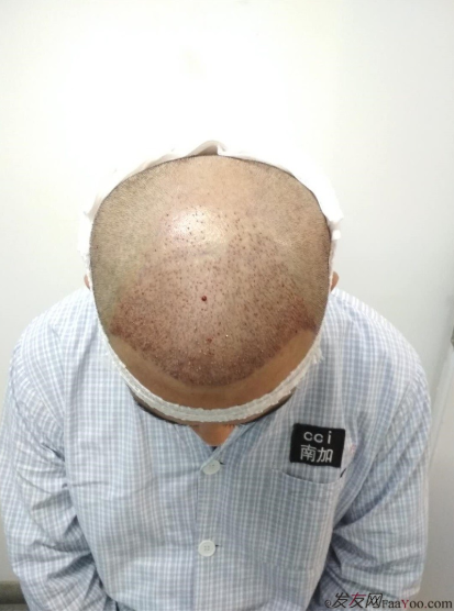 北京南加植發(fā)唐醫(yī)生種植3500單位一年效果恢復(fù)全程記錄