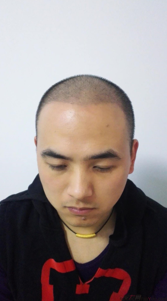 北京南加植發(fā)唐醫(yī)生種植3500單位一年效果恢復(fù)全程記錄