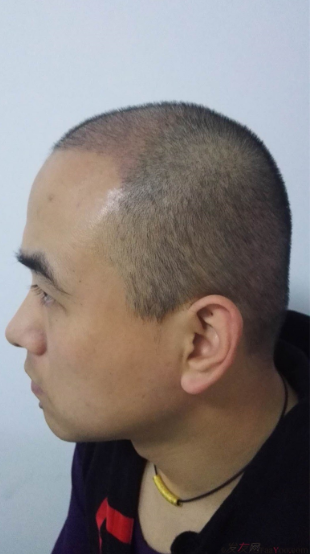 北京南加植發(fā)唐醫(yī)生種植3500單位一年效果恢復(fù)全程記錄