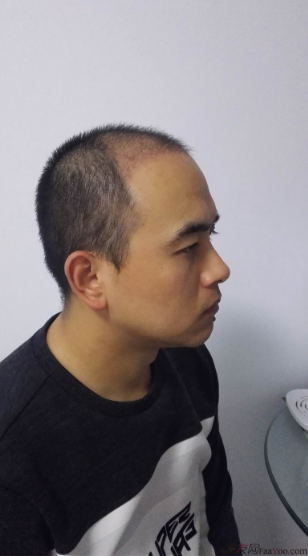 北京南加植發(fā)唐醫(yī)生種植3500單位一年效果恢復(fù)全程記錄