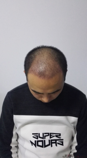 北京南加植發(fā)唐醫(yī)生種植3500單位一年效果恢復(fù)全程記錄