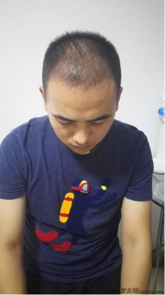 北京南加植發(fā)唐醫(yī)生種植3500單位一年效果恢復(fù)全程記錄