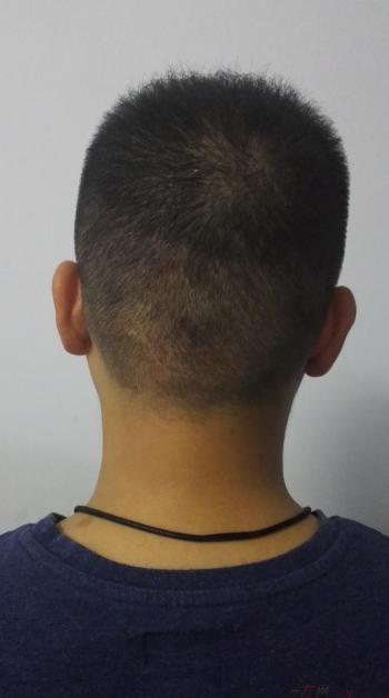 北京南加植發(fā)唐醫(yī)生種植3500單位一年效果恢復(fù)全程記錄