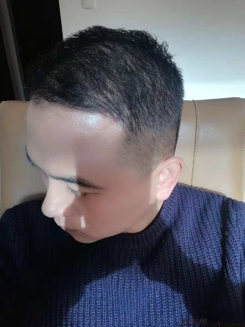 北京南加植發(fā)唐醫(yī)生種植3500單位一年效果恢復(fù)全程記錄