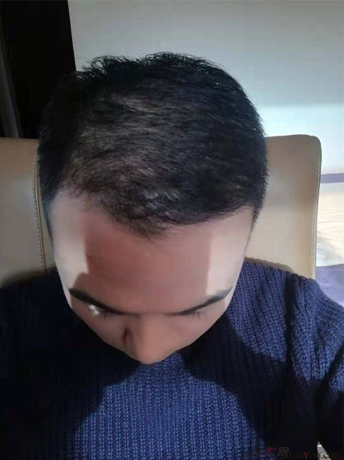 北京南加植發(fā)唐醫(yī)生種植3500單位一年效果恢復(fù)全程記錄