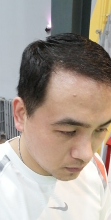 北京南加植發(fā)唐醫(yī)生種植3500單位一年效果恢復(fù)全程記錄