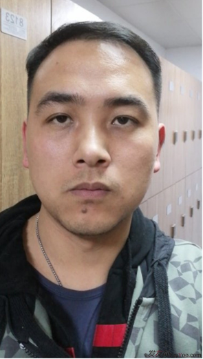 北京南加植發(fā)唐醫(yī)生種植3500單位一年效果恢復(fù)全程記錄